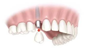 implant replacing one tooth in mouth, dental implants Mahwah, NJ