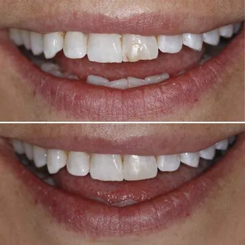 before and after image of chipped front tooth then fixed tooth after dental bonding Brookline, MA dentist