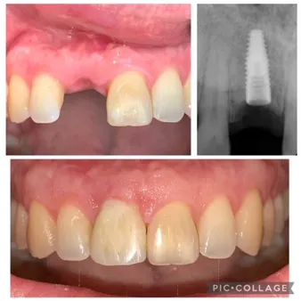 implant