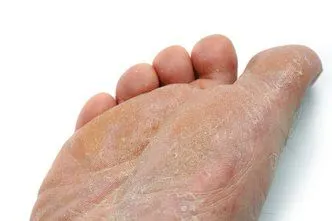 Brooklyn Podiatrist | Brooklyn Athlete's Foot | NY | Dr Inna Verzub - Modern Podiatry PC |