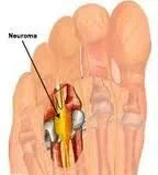 Mortons_Neuroma1.jpg