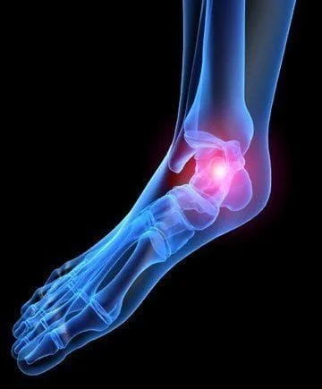 Haglunds Deformity | Heel Pain Treatment | Melbourne Podiatrist
