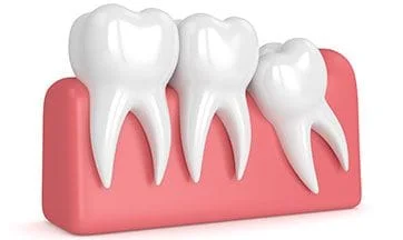 wisdom tooth removal mississauga dentist