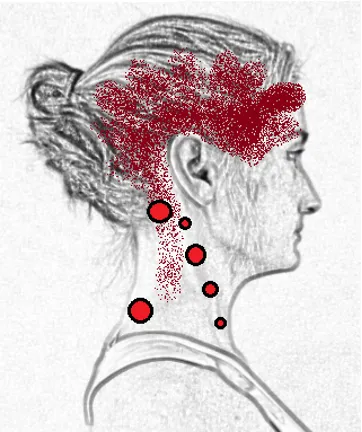 Headache from trigger point migraine chiropractor