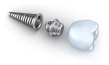 dental implant assembly Manteca, CA