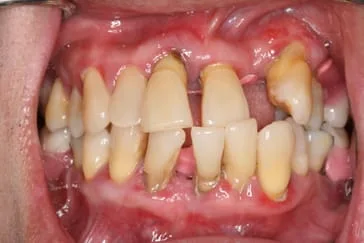 Failed mouth periodontal disease