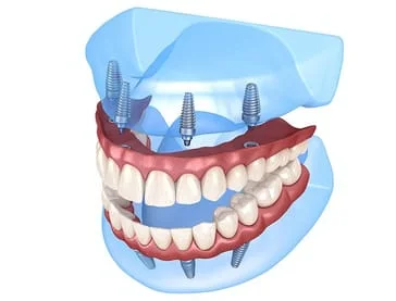 all on 4 dental implant teeth in a day mississauga