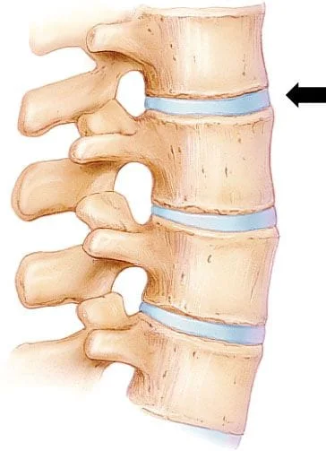 Herniated disc treatment NYC. Treatments for herniated discs in New York City, Soho Manhattan. A spinal column showing the vertebrae and herniated discs of the back, the cause of back pain. Get chiropractic treatment for herniated discs at our Manhattan NYC clinic