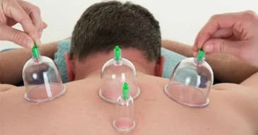 Cupping-Therapy.jpg