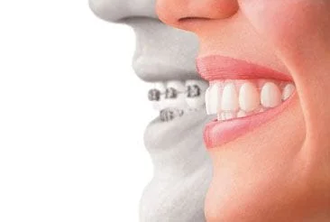 The Importance of Phase 1 Orthodontic Treatment: EZ Dental: Family Dentists