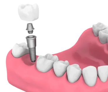 Implant | Dentist In Fircrest, WA | Emerson Dental