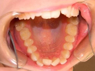 Invisalign Before