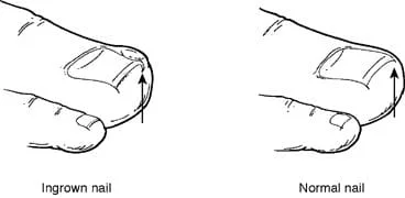 Ingrown Toenails in Concord and Meredith, NH