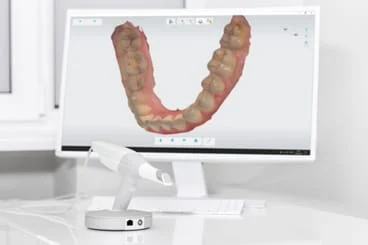 Itero Digital Impressions, Bridgeport Family Dentist