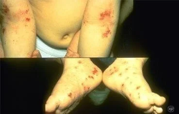 atopic-dermatitis-symptoms_feet
