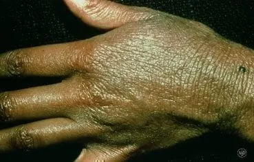 atopic-dermatitis-symptoms_hand