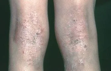 atopic_dermatitis_symptomos_knees
