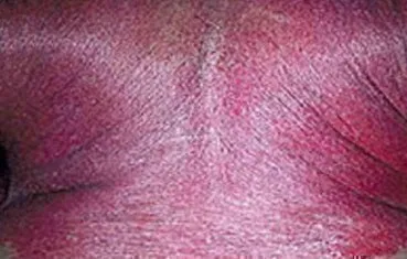 psoriasis-symptoms-erythrodermic.jpg