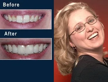 Alabama dentist - gum restructuring and porcelain veneers