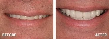 before_after_ortho