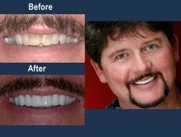 veneers for tetracycline stains