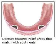 Implant-supported denture