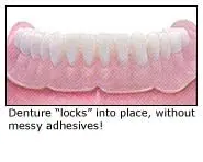 Implant-supported denture