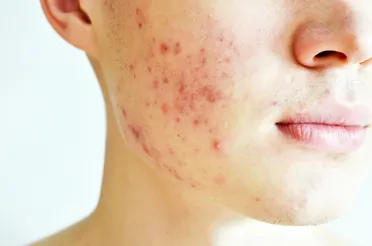 Acne Pathogenesis