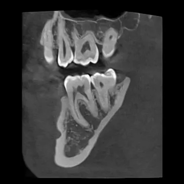 CBCT