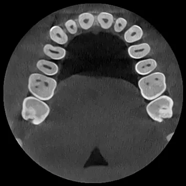 CBCT