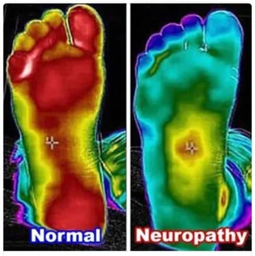 diabetic neuropathy thermal scan