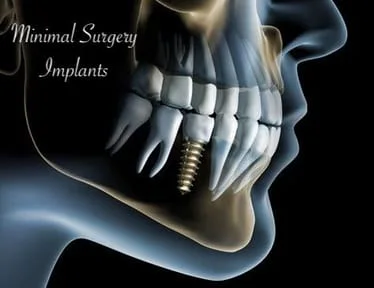 Minimal Surgery Implants | Walker Dentistry in Fishers, IN