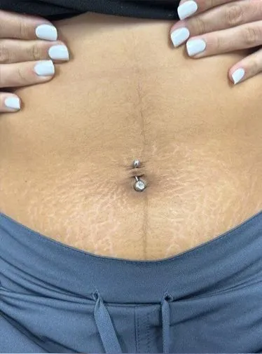 Stretch Mark Before