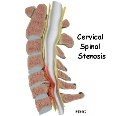 Best Exercises for Stenosis in the Cervical Spine