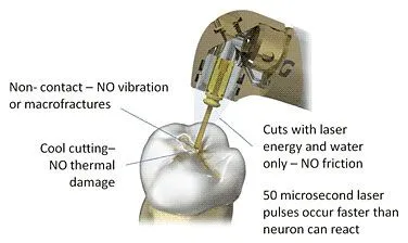 laser dentistry in Houston, TX