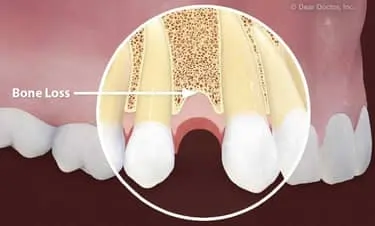 Dental Implants Newton MA 