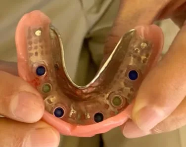 Locator denture attachments in denture