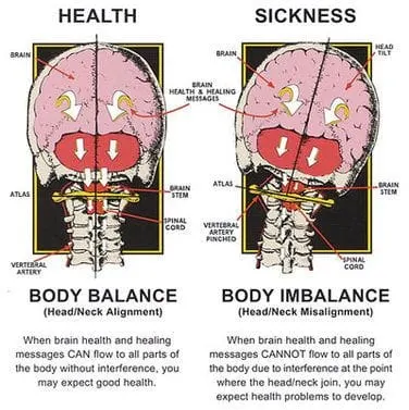 diagram of healthy aligned upper cervical spine vs misaligned upper cervical spine that results in health problems