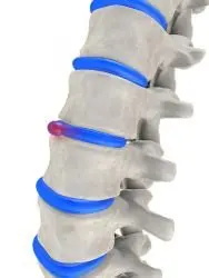 bulging disc, Lubbock chiropractor