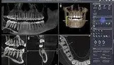 digital CBCT scan of person's mouth to evaluate bone density for dental implants New Baltimore, MI dentist