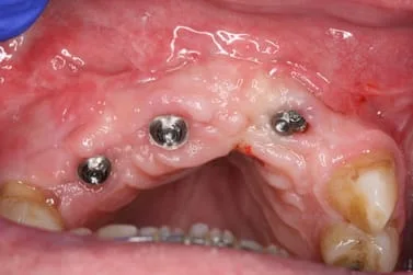 Dental trauma rebuilt with implants