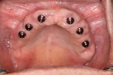 loose dentures upper implants