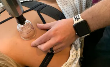 cupping therapy