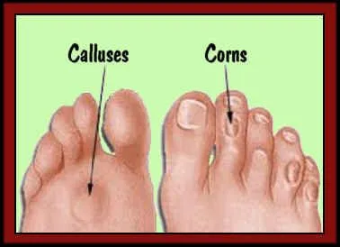 Calluses and Corns  Foot and Ankle Specialists