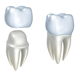 illustration of crown being placed over prepared tooth, dental crowns Charlotte, NC dentist