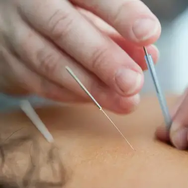 Acupuncture