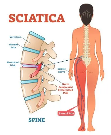 Sciatica Diagram