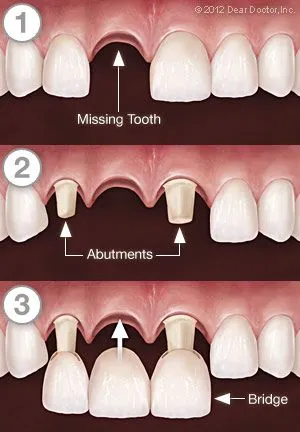 Dental Bridge Step by Step St. Clair Shores, MI & Grosse Pointe Woods, MI