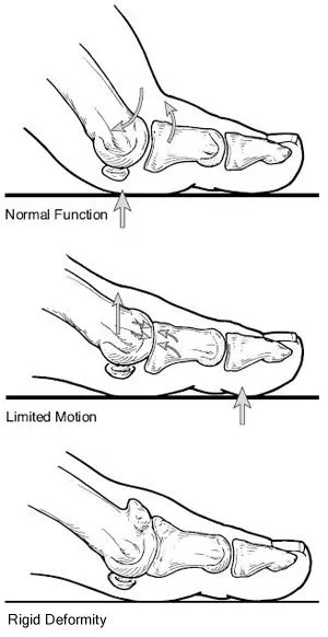 Hallux_Rigidus1.jpg