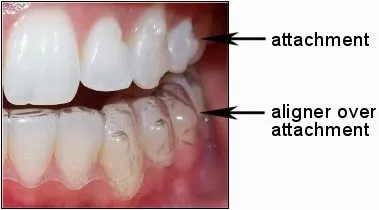 Removing Invisalign Buttons the Right Way - Seasons of Smiles